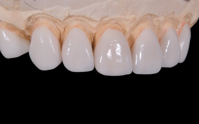 Internal bleaching tooth Media VIP from INDIA